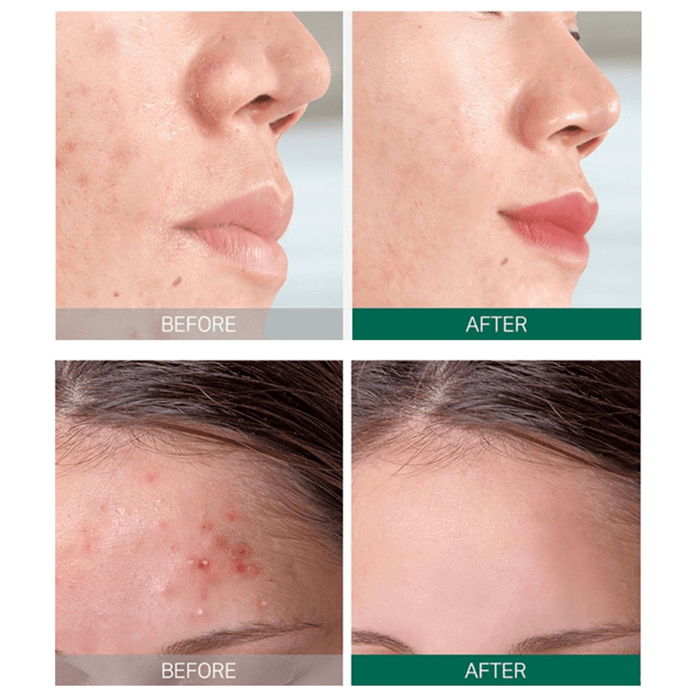 SOME BY MI – AHA, BHA, PHA 30 Days Miracle Starter KIT